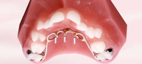 When Does a Child Need a Thumb Sucking Appliance?