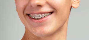 Traditional Braces
