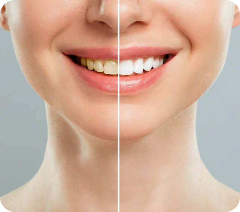 teeth-whitening-advantage